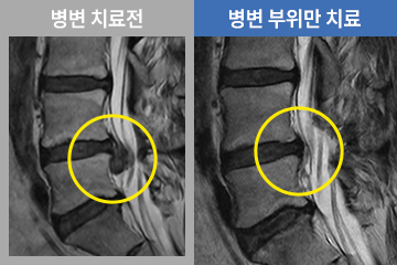 양방향 척추 내시경술의 수술과정 STEP4